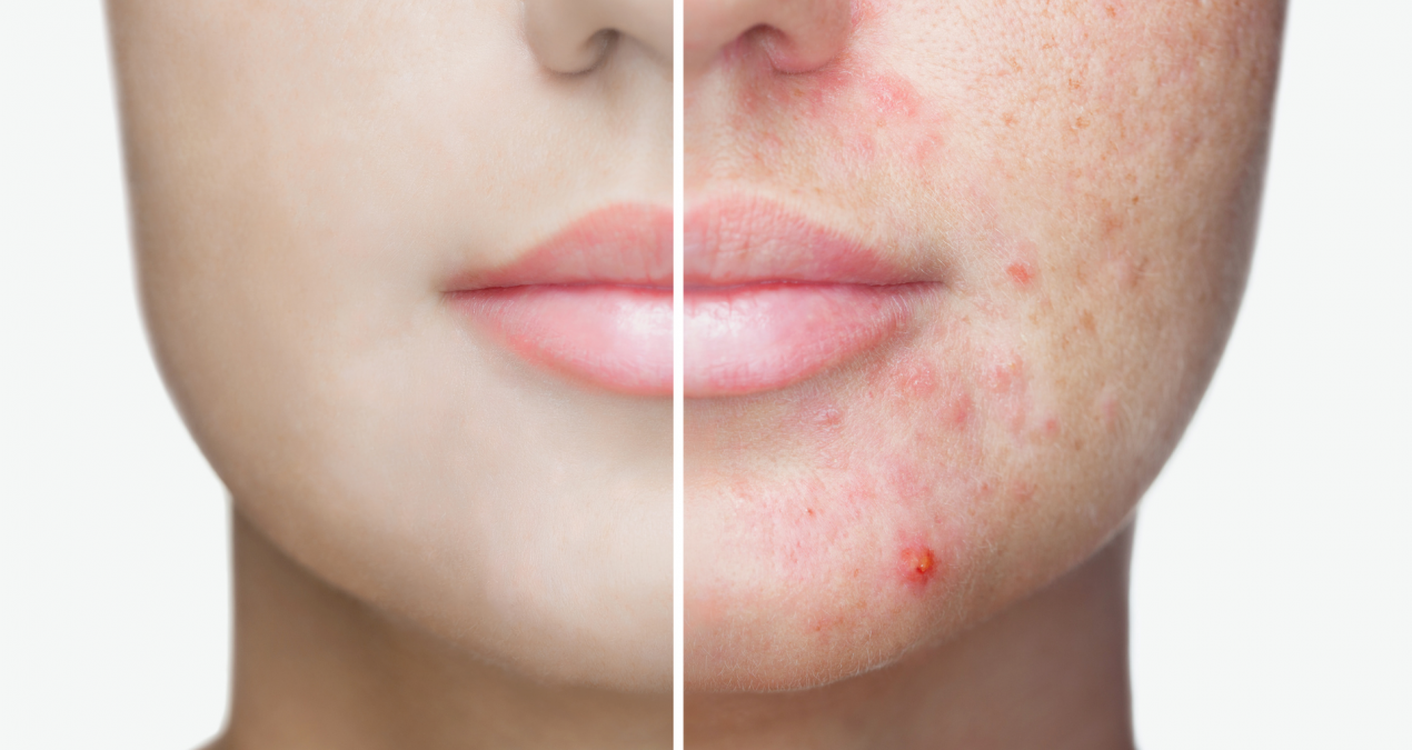 How To Treat Acne As You Get Older
